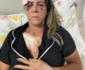 Polícia Civil abre inquérito para investigar ataque de Pitbull em Petrolina; prefeitura se manifesta