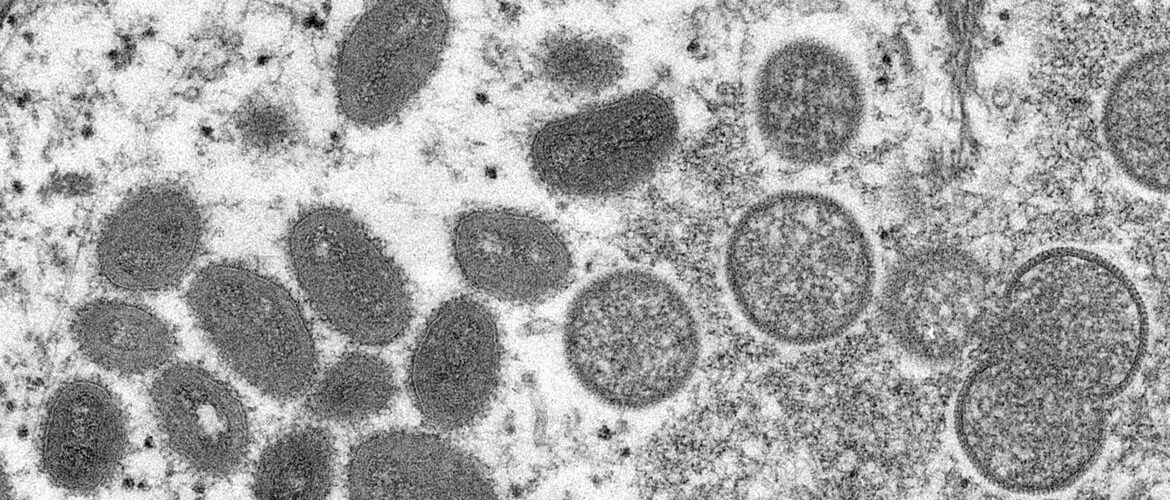 Saúde confirma primeira morte relacionada à varíola dos macacos