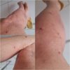 “O governo Andrei está sendo um fracasso no combate às muriçocas”: Sob o ataque das muriçocas moradores de Juazeiro cobram ações urgentes da prefeitura