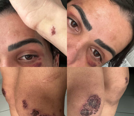 Modelo trans é brutalmente agredida na Ilha do Fogo após reclamar de filmagens; OSC Cores denuncia caso